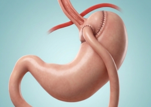 GI surgery Surat gastrointestinal surgeon Dr Nainesh Patel laparoscopic procedures