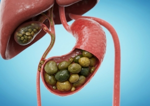 gallbladder surgery Surat gallstone advanced laparoscopic surgeon Dr Nainesh Patel