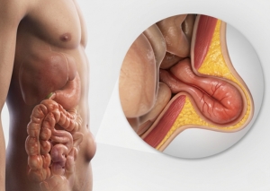Advanced Laparoscopic hernia surgery in Surat by Dr Nainesh Patel laparoscopic hernia surgeon