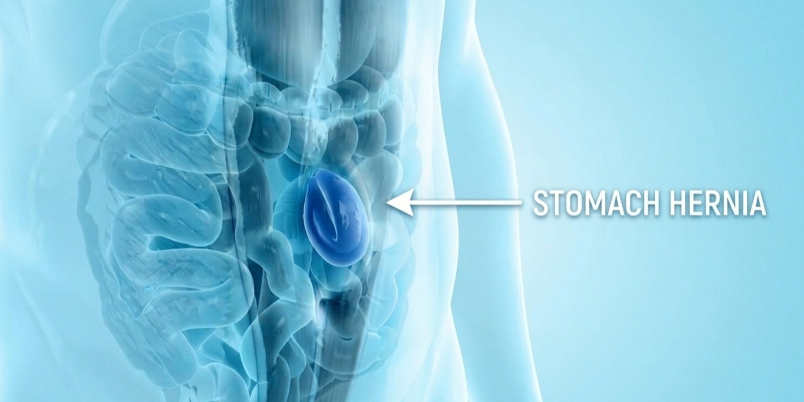 🏥 Best Hernia Surgeon in Surat | Laparoscopic Hernia Surgery | Dr Nainesh Patel